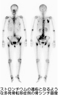 多発骨転移症例